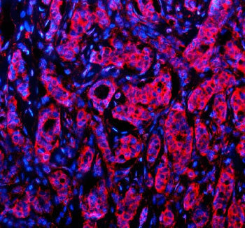 Immunofluorescent staining of NID1 using anti-NID1 antibody (red). NID1 was detected in a paraffin-embedded section of human breast cancer tissue. Heat mediated antigen retrieval was performed in EDTA buffer (pH 8.0, epitope retrieval solution). The tissue section was blocked with 10% goat serum. The tissue section was then incubated with 5 ug/ml rabbit anti-NID1 antibody overnight at 4oC. Cy3 Conjugated Goat Anti-Rabbit IgG was used as secondary antibody at 1:500 dilution and incubated for 30 min at 37oC.