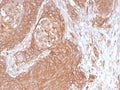 IHC testing of FFPE human pancreatic cancer with recombinant Spectrin beta III antibody (clone SPTBN2/2894R). Required HIER: boil tissue sections in pH 9 10mM Tris with 1mM EDTA for 10-20 min followed by cooling at RT for 20 min.
