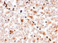 IHC staining of FFPE human liver with APOA1 antibody. HIER: boil tissue sections in pH 9 10mM Tris with 1mM EDTA for 20 min and allow to cool before testing.
