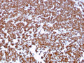IHC staining of FFPE human tonsil tissue with CD20 antibody (clone MS4A1/3409). HIER: boil tissue sections in pH6, 10mM citrate buffer, for 10-20 min and allow to cool before testing.