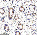Immunohistochemical staining of GLOD5 using anti-GLOD5 antibody. GLOD5 was detected in a paraffin-embedded section of human stomach cancer tissue. Heat mediated antigen retrieval was performed in EDTA buffer (pH 8.0, epitope retrieval solution). The tissue section was blocked with 10% goat serum. The tissue section was then incubated with 2 ug/ml rabbit anti-GLOD5 antibody overnight at 4oC. Peroxidase Conjugated Goat Anti-rabbit IgG was used as secondary antibody and incubated for 30 min at 37oC.