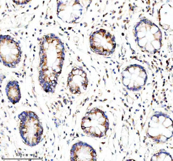 Immunohistochemical staining of GLOD5 using anti-GLOD5 antibody. GLOD5 was detected in a paraffin-embedded section of human stomach cancer tissue. Heat mediated antigen retrieval was performed in EDTA buffer (pH 8.0, epitope retrieval solution). The tissue section was blocked with 10% goat serum. The tissue section was then incubated with 2 ug/ml rabbit anti-GLOD5 antibody overnight at 4oC. Peroxidase Conjugated Goat Anti-rabbit IgG was used as secondary antibody and incubated for 30 min at 37oC.
