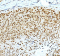 IHC staining of FFPE human skin cancer tissue with Krueppel-like factor 4 antibody, HRP-secondary and DAB substrate. HIER: boil tissue sections in pH8 EDTA for 20 min and allow to cool before testing.