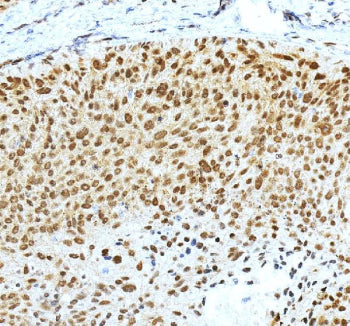 IHC staining of FFPE human skin cancer tissue with Krueppel-like factor 4 antibody, HRP-secondary and DAB substrate. HIER: boil tissue sections in pH8 EDTA for 20 min and allow to cool before testing.
