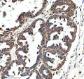 IHC analysis of GHRHR using anti-GHRHR antibody. GHRHR was detected in a paraffin-embedded section of human prostate cancer tissue. Heat mediated antigen retrieval was performed in EDTA buffer (pH 8.0, epitope retrieval solution). The tissue section was blocked with 10% goat serum. The tissue section was then incubated with 2 ug/ml rabbit anti-GHRHR antibody overnight at 4oC. Peroxidase Conjugated Goat Anti-rabbit IgG was used as secondary antibody and incubated for 30 min at 37oC.