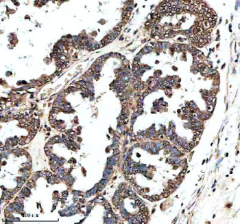 IHC analysis of GHRHR using anti-GHRHR antibody. GHRHR was detected in a paraffin-embedded section of human prostate cancer tissue. Heat mediated antigen retrieval was performed in EDTA buffer (pH 8.0, epitope retrieval solution). The tissue section was blocked with 10% goat serum. The tissue section was then incubated with 2 ug/ml rabbit anti-GHRHR antibody overnight at 4oC. Peroxidase Conjugated Goat Anti-rabbit IgG was used as secondary antibody and incubated for 30 min at 37oC.