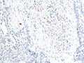 IHC staining of FFPE human lung squamous carcinoma tissue with recombinant Granzyme B antibody at 1:200.
