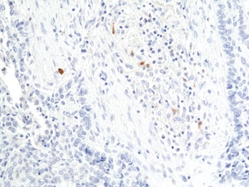 IHC staining of FFPE human lung squamous carcinoma tissue with recombinant Granzyme B antibody at 1:200.