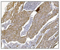 IHC staining of FFPE human breast cancer tissue with Nudel antibody. HIER: boil tissue sections in pH8 EDTA for 20 min and allow to cool before testing.