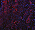 Immunofluorescent staining of FFPE human intestinal cancer tissue with PP18 antibody (red) and DAPI nuclear stain (blue). HIER: steam section in pH8 EDTA buffer for 20 min.