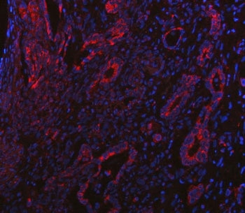 Immunofluorescent staining of FFPE human intestinal cancer tissue with PP18 antibody (red) and DAPI nuclear stain (blue). HIER: steam section in pH8 EDTA buffer for 20 min.