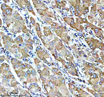 IHC analysis of SUCO using anti-SUCO antibody. SUCO was detected in a paraffin-embedded section of human pancreas cancer tissue. Heat mediated antigen retrieval was performed in EDTA buffer (pH 8.0, epitope retrieval solution). The tissue section was blocked with 10% goat serum. The tissue section was then incubated with 2 ug/ml rabbit anti-SUCO antibody overnight at 4oC. Peroxidase Conjugated Goat Anti-rabbit IgG was used as secondary antibody and incubated for 30 min at 37oC.