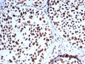 IHC staining of FFPE human breast carcinoma tissue with HSP70-2 antibody (clone HSPA1B/7625). HIER: boil tissue sections in pH 9 10mM Tris with 1mM EDTA for 20 min and allow to cool before testing.