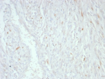 IHC staining of FFPE human liposarcoma tissue with MDM2 antibody (clone MDM2/8221). HIER: boil tissue sections in pH 9 10mM Tris with 1mM EDTA for 20 min and allow to cool before testing.