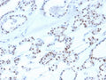 IHC staining of FFPE human thyroid with recombinant PAX8 antibody. HIER: boil tissue sections in pH 9 10mM Tris with 1mM EDTA for 20 min and allow to cool before testing.