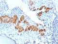 IHC testing of FFPE human breast carcinoma with recombinant SMMHC antibody (clone MYH11/2303R). Required HIER: boil tissue sections in pH 9 10mM Tris with 1mM EDTA for 10-20 min followed by cooling at RT for 20 min.