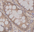 Immunohistochemical staining of OAZ1 using anti-OAZ1 antibody. OAZ1 was detected in a paraffin-embedded section of human colon cancer tissue. Heat mediated antigen retrieval was performed in EDTA buffer (pH 8.0, epitope retrieval solution). The tissue section was blocked with 10% goat serum. The tissue section was then incubated with 2 ug/ml rabbit anti-OAZ1 antibody overnight at 4oC. Peroxidase Conjugated Goat Anti-rabbit IgG was used as secondary antibody and incubated for 30 min at 37oC.