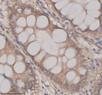 Immunohistochemical staining of OAZ1 using anti-OAZ1 antibody. OAZ1 was detected in a paraffin-embedded section of human colon cancer tissue. Heat mediated antigen retrieval was performed in EDTA buffer (pH 8.0, epitope retrieval solution). The tissue section was blocked with 10% goat serum. The tissue section was then incubated with 2 ug/ml rabbit anti-OAZ1 antibody overnight at 4oC. Peroxidase Conjugated Goat Anti-rabbit IgG was used as secondary antibody and incubated for 30 min at 37oC.