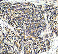 Immunohistochemical staining of PPP2R5E using anti-PPP2R5E antibody. PPP2R5E was detected in a paraffin-embedded section of human stomach cancer tissue. Heat mediated antigen retrieval was performed in EDTA buffer (pH 8.0, epitope retrieval solution). The tissue section was blocked with 10% goat serum. The tissue section was then incubated with 2 ug/ml rabbit anti-PPP2R5E antibody overnight at 4oC. Peroxidase Conjugated Goat Anti-rabbit IgG was used as secondary antibody and incubated for 30 min at 37oC.