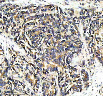 Immunohistochemical staining of PPP2R5E using anti-PPP2R5E antibody. PPP2R5E was detected in a paraffin-embedded section of human stomach cancer tissue. Heat mediated antigen retrieval was performed in EDTA buffer (pH 8.0, epitope retrieval solution). The tissue section was blocked with 10% goat serum. The tissue section was then incubated with 2 ug/ml rabbit anti-PPP2R5E antibody overnight at 4oC. Peroxidase Conjugated Goat Anti-rabbit IgG was used as secondary antibody and incubated for 30 min at 37oC.