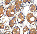 Immunohistochemical staining of ADAMTS1 using anti-ADAMTS1 antibody. ADAMTS1 was detected in a paraffin-embedded section of human breast cancer tissue. Heat mediated antigen retrieval was performed in EDTA buffer (pH 8.0, epitope retrieval solution). The tissue section was blocked with 10% goat serum. The tissue section was then incubated with 2 ug/ml rabbit anti-ADAMTS1 antibody overnight at 4oC. Peroxidase Conjugated Goat Anti-rabbit IgG was used as secondary antibody and incubated for 30 min at 37oC.