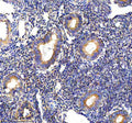 Immunohistochemical staining of PALS1 using anti-PALS1 antibody. PALS1 was detected in a paraffin-embedded section of human endometrial cancer tissue. Heat mediated antigen retrieval was performed in EDTA buffer (pH 8.0, epitope retrieval solution). The tissue section was blocked with 10% goat serum. The tissue section was then incubated with 2 ug/ml rabbit anti-PALS1 antibody overnight at 4oC. Peroxidase Conjugated Goat Anti-rabbit IgG was used as secondary antibody and incubated for 30 min at 37oC.