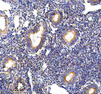 Immunohistochemical staining of PALS1 using anti-PALS1 antibody. PALS1 was detected in a paraffin-embedded section of human endometrial cancer tissue. Heat mediated antigen retrieval was performed in EDTA buffer (pH 8.0, epitope retrieval solution). The tissue section was blocked with 10% goat serum. The tissue section was then incubated with 2 ug/ml rabbit anti-PALS1 antibody overnight at 4oC. Peroxidase Conjugated Goat Anti-rabbit IgG was used as secondary antibody and incubated for 30 min at 37oC.