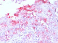IHC testing FFPE human melanoma with recombinant Melan-A antibody (clone MLANA/1761R). HIER: steam sections in pH 9 10mM Tris with 1mM EDTA for 10-20 min.