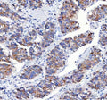 IHC staining of FFPE human liver cancer tissue with Amyloid-like protein 2 antibody. HIER: boil tissue sections in pH8 EDTA for 20 min and allow to cool before testing.