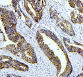 IHC staining of FFPE human colon cancer with Tafazzin antibody. HIER: boil tissue sections in pH8 EDTA buffer for 20 min and allow to cool before testing.