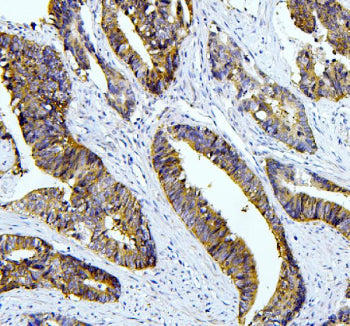 IHC staining of FFPE human colon cancer with Tafazzin antibody. HIER: boil tissue sections in pH8 EDTA buffer for 20 min and allow to cool before testing.