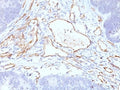 IHC: Formalin-fixed, paraffin-embedded colon carcinoma stained with CD31 antibody cocktail (C31.3+C31.7+C31.10).