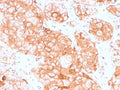 IHC staining of FFPE human testicular carcinoma with recombinant Prolactin Receptor antibody (clone PRLR/3785R). HIER: boil tissue sections in pH 9 10mM Tris with 1mM EDTA for 20 min and allow to cool before testing.