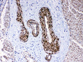 IHC testing of FFPE human lung cancer tissue with CPI-17 antibody at 1ug/ml. Required HIER: steam section in pH6 citrate buffer for 20 min and allow to cool prior to testing.
