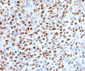 IHC staining of FFPE human melanoma with recombinant MITF antibody (clone MPAF3-2R). HIER: boil tissue sections in pH 9 10mM Tris with 1mM EDTA for 10-20 min and allow to cool before testing.