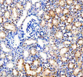 Immunohistochemical staining of MINPP1 using anti-MINPP1 antibody. MINPP1 was detected in a paraffin-embedded section of human thyroid cancer tissue. Heat mediated antigen retrieval was performed in EDTA buffer (pH 8.0, epitope retrieval solution). The tissue section was blocked with 10% goat serum. The tissue section was then incubated with 2 ug/ml rabbit anti-MINPP1 antibody overnight at 4oC. Peroxidase Conjugated Goat Anti-rabbit IgG was used as secondary antibody and incubated for 30 min at 37oC.