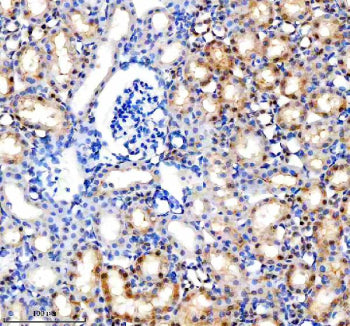 Immunohistochemical staining of MINPP1 using anti-MINPP1 antibody. MINPP1 was detected in a paraffin-embedded section of human thyroid cancer tissue. Heat mediated antigen retrieval was performed in EDTA buffer (pH 8.0, epitope retrieval solution). The tissue section was blocked with 10% goat serum. The tissue section was then incubated with 2 ug/ml rabbit anti-MINPP1 antibody overnight at 4oC. Peroxidase Conjugated Goat Anti-rabbit IgG was used as secondary antibody and incubated for 30 min at 37oC.