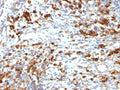 IHC: Formalin-fixed, paraffin-embedded human lymphoma stained with CD79a antibody (clone IGA/764).