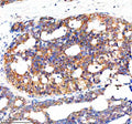 Immunohistochemical staining of NCR3LG1 using anti-NCR3LG1 antibody. NCR3LG1 was detected in a paraffin-embedded section of human breast cancer tissue. Heat mediated antigen retrieval was performed in EDTA buffer (pH 8.0, epitope retrieval solution). The tissue section was blocked with 10% goat serum. The tissue section was then incubated with 2 ug/ml rabbit anti-NCR3LG1 antibody overnight at 4oC. Peroxidase Conjugated Goat Anti-rabbit IgG was used as secondary antibody and incubated for 30 min at 37oC.