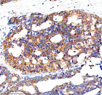 Immunohistochemical staining of NCR3LG1 using anti-NCR3LG1 antibody. NCR3LG1 was detected in a paraffin-embedded section of human breast cancer tissue. Heat mediated antigen retrieval was performed in EDTA buffer (pH 8.0, epitope retrieval solution). The tissue section was blocked with 10% goat serum. The tissue section was then incubated with 2 ug/ml rabbit anti-NCR3LG1 antibody overnight at 4oC. Peroxidase Conjugated Goat Anti-rabbit IgG was used as secondary antibody and incubated for 30 min at 37oC.