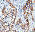 IHC staining of FFPE human bladder cancer tissue with AQP3 antibody. HIER: boil tissue sections in pH8 EDTA for 20 min and allow to cool before testing.