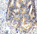 Immunohistochemical staining of FBXO7 using anti-FBXO7 antibody. FBXO7 was detected in a paraffin-embedded section of human endometrial cancer tissue. Heat mediated antigen retrieval was performed in EDTA buffer (pH 8.0, epitope retrieval solution). The tissue section was blocked with 10% goat serum. The tissue section was then incubated with 2 ug/ml rabbit anti-FBXO7 antibody overnight at 4oC. Peroxidase Conjugated Goat Anti-rabbit IgG was used as secondary antibody and incubated for 30 min at 37oC.