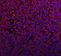 Immunofluorescent staining of FFPE human glioma tissue with PYCR1 antibody (red) and DAPI nuclear stain (blue). HIER: steam section in pH8 EDTA buffer for 20 min.