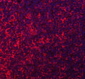 Immunofluorescent staining of FFPE human breast cancer tissue with Acyl-CoA dehydrogenase family member 9 antibody (red) and DAPI nuclear stain (blue). HIER: steam section in pH8 EDTA buffer for 20 min.