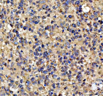 IHC staining of FFPE human glioblastoma tissue with NOTCH2 antibody. HIER: boil tissue sections in pH8 EDTA for 20 min and allow to cool before testing.