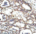Immunohistochemical staining of PAN3 using anti-PAN3 antibody. PAN3 was detected in a paraffin-embedded section of human pancreas cancer tissue. Heat mediated antigen retrieval was performed in EDTA buffer (pH 8.0, epitope retrieval solution). The tissue section was blocked with 10% goat serum. The tissue section was then incubated with 2 ug/ml rabbit anti-PAN3 antibody overnight at 4oC. Peroxidase Conjugated Goat Anti-rabbit IgG was used as secondary antibody and incubated for 30 min at 37oC.