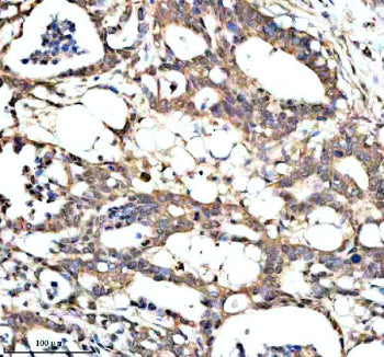 Immunohistochemical staining of PAN3 using anti-PAN3 antibody. PAN3 was detected in a paraffin-embedded section of human pancreas cancer tissue. Heat mediated antigen retrieval was performed in EDTA buffer (pH 8.0, epitope retrieval solution). The tissue section was blocked with 10% goat serum. The tissue section was then incubated with 2 ug/ml rabbit anti-PAN3 antibody overnight at 4oC. Peroxidase Conjugated Goat Anti-rabbit IgG was used as secondary antibody and incubated for 30 min at 37oC.