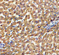 Immunohistochemical staining of TIMM9 using anti-TIMM9 antibody. TIMM9 was detected in a paraffin-embedded section of human liver cancer tissue. Heat mediated antigen retrieval was performed in EDTA buffer (pH 8.0, epitope retrieval solution). The tissue section was blocked with 10% goat serum. The tissue section was then incubated with 2 ug/ml rabbit anti-TIMM9 antibody overnight at 4oC. Peroxidase Conjugated Goat Anti-rabbit IgG was used as secondary antibody and incubated for 30 min at 37oC.