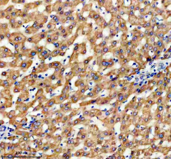 Immunohistochemical staining of TIMM9 using anti-TIMM9 antibody. TIMM9 was detected in a paraffin-embedded section of human liver cancer tissue. Heat mediated antigen retrieval was performed in EDTA buffer (pH 8.0, epitope retrieval solution). The tissue section was blocked with 10% goat serum. The tissue section was then incubated with 2 ug/ml rabbit anti-TIMM9 antibody overnight at 4oC. Peroxidase Conjugated Goat Anti-rabbit IgG was used as secondary antibody and incubated for 30 min at 37oC.