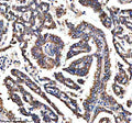Immunohistochemical staining of RASAL3 using anti-RASAL3 antibody. RASAL3 was detected in a paraffin-embedded section of human lung cancer tissue. Heat mediated antigen retrieval was performed in EDTA buffer (pH 8.0, epitope retrieval solution). The tissue section was blocked with 10% goat serum. The tissue section was then incubated with 2 ug/ml rabbit anti-RASAL3 antibody overnight at 4oC. Peroxidase Conjugated Goat Anti-rabbit IgG was used as secondary antibody and incubated for 30 min at 37oC.